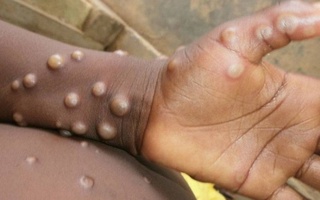 В Конго объявили эпидемию оспы обезьян