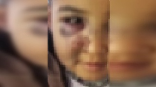 Murgʻak bolakay otasi tomonidan kaltaklangani aytilmoqda