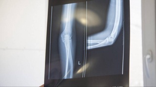 Ученые научились лечить переломы с помощью плазмы