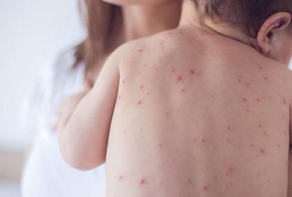 In Uzbekistan, doctors note that the situation with measles does not cause concern