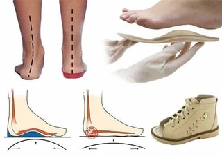 Қант диабетімен ауыратын науқастар үшін ортопедиялық аяқ киім ойлап табылды