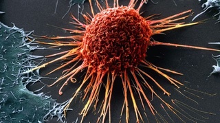 ЖССТ энг кўп тарқалган саратон турини маълум қилди