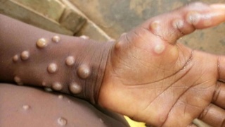 Аҳолининг аксарият қисмида маймун чечакка қарши жамоавий иммунитет мавжуд — Санэпидқўмита