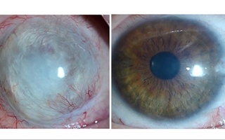 Ko'rish qobiliyatini tiklovchi innovatsion usuli ishlab chiqildi