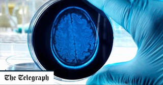 Aлцгеймер касаллигининг давоси 2040 йилгача топилиши мумкин