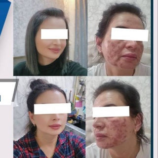 Гўзаллик салони мутахассиси мижозининг юз терисини куйдириб қўйди