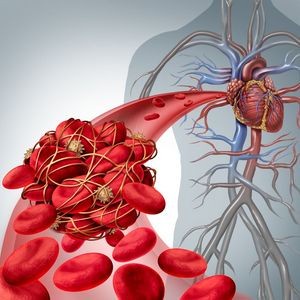 CОVID-19 билан касалланганларда тромбоз хавфи юқори