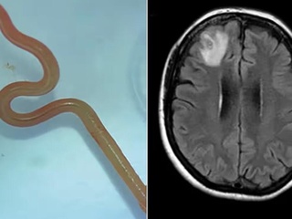 Avstraliyada shifokorlar bemorning miyasidan sakkiz santimetrlik qurtni olib tashlashdi