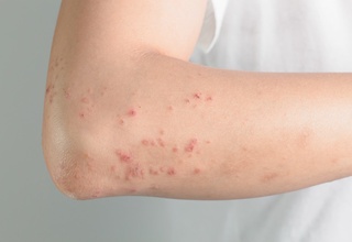 Koronavirusga chalinganlarda nega toshmalar yuzaga keladi?