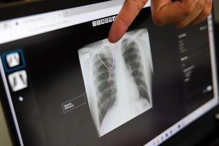 Sil va oʻpka kasalliklariga sunʼiy intellekt yordamida tashxis qoʻyiladi