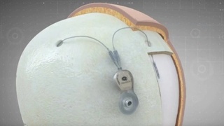 Хитой дунёдаги биринчи мия сигналларини йиғувчи инвазив мосламани ишга туширди