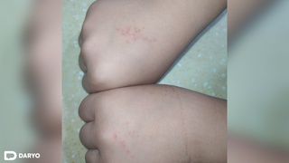 Bolalarni qoʻliga igna sanchish orqali tarbiyalashga uringan oʻqituvchi ishdan boʻshatildi