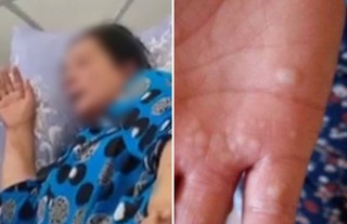 Андижонда "маймун чечак"ка чалиниш ҳолати қайд этилгани ростми?