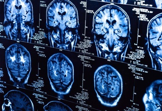 Avstraliyalik olimlar miya saratoniga qarshi kurashishning samarali usilini ishlab chiqishdi