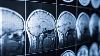 Miya kasalliklarini MRTsiz aniqlash usuli topildi