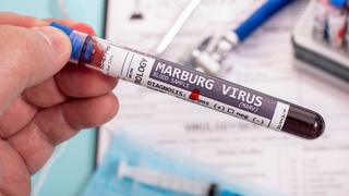 Marburg virusi dunyoda yangi pandemiyaga sabab boʻlishi mumkin
