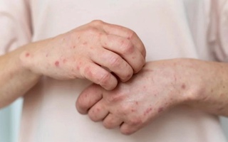 Bangladeshda qizamiq epidemiyasi: so‘nggi 24 soat ichida 17 kishi vafot etdi