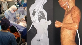 Бахтсиз ҳодиса туфайли ўта оғир тан жароҳати олган беморнинг ҳаёти сақлаб қолинди