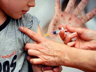 ЖССТ: Дунёда қизамиқ инфекциясининг кенг тарқалиш хавфи юқори