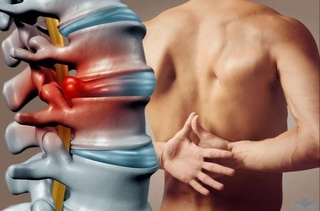 Российские ученые разработали биоразлагаемый протез для лечения грыж и остеохондроза