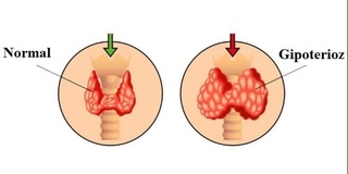 Gipoteriozda nevrologik buzilishlarni prognozlash va erta aniqlash usuli yaratildi
