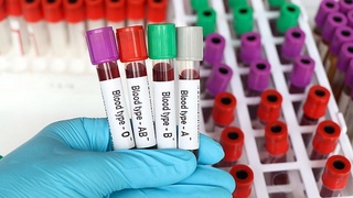 Олимлар қон гуруҳи ва эрта инсулт хавфи ўртасидаги боғлиқликни аниқлади