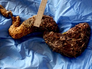 Qashqadaryoda 20 yoshli bemor oshqozonidan 1 kilogramm 400 gramm soch toʻplami olib tashlandi