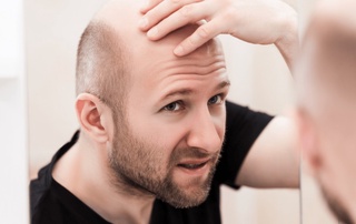 Sifatsiz “ekilgan“ sochlar qisqa muddatda toʻkilib tushdi