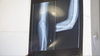 Олимлар плазмали нурланиш ёрдамида синган суякларни даволаш усулини ишлаб чиқишди