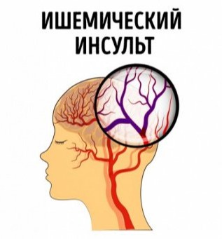 Ишемик инсультнинг олдини олиш йўли топилди