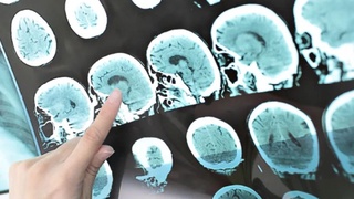 Риск инсульта при коронавирусе в шесть раз выше, чем при гриппе