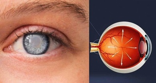 Glaucoma - why is it called the "silent killer" of vision?