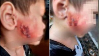 В столичном детском саду трехлетнему ребенку обожгли лицо