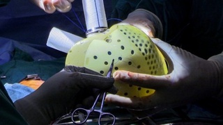 Тарихда биринчи марта беморга сунъий юрак ўрнатилди