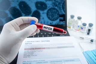 JSST: Dunyoda maymun chechagini yuqtirish holatlari rekord darajaga yetdi