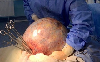 Kropivnitskiyda onkologlar bemordan 10 kilogramm og'irlikdagi o'simtani olib tashlashdi