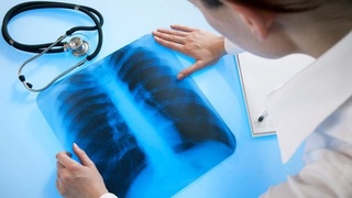 ЖССТ: Сил касаллигини даволаш муддатини 6 ойдан 4 ойга қисқартиш мумкин