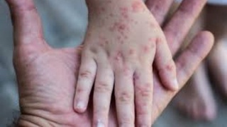 Бутунжаҳон соғлиқни сақлаш тармоғи маймун чечаги эпидемиясини пандемия деб эълон қилди