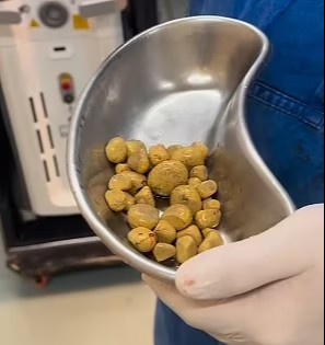 Kuniga uch litrgacha Coca-Cola ichadigan erkakning peshob qopchasidan 35 dona tosh olib tashlandi