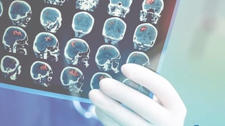 Миллий палата лойиҳаси: инсультни дастлабки 4 соатда аниқлаш мумкин