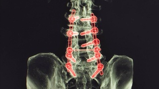Orqa miya implantatsiyasi Parkinson kasalligiga chalingan odamga yurish imkonini berdi