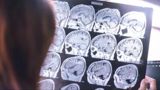 Demensiyaning oldini olishning samarali usuli topildi