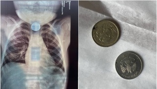 Buxoroda 2 yoshli bola ikkita tangani yutib yubordi