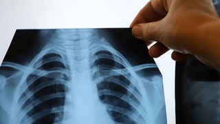 COVID-19 дан кейин ўпкани тиклаш усуллари – иммунолог тавсияси