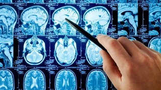 Паркинсон касаллигида мияни тиклаш йўли топилди