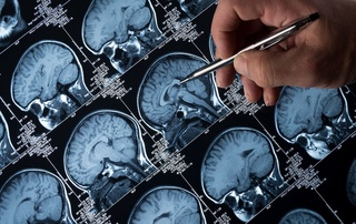 Bosh miya kasalliklarini davolashda nanorobotlardan foydalanilishi mumkin