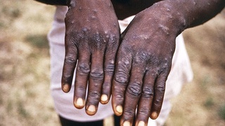 Hindistonda maymunchechakka qarshi vaktsina ishlab chiqilmoqda