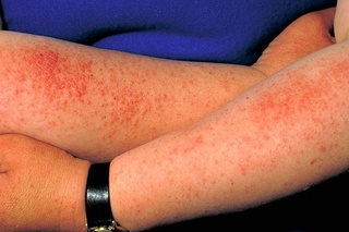 Quyosh nuri allergik reaksiyalarni keltirib chiqarishi mumkin