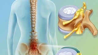 Umurtqalararo disk churrasi: Kasallikni operatsiyasiz davolash mumkinmi?