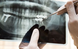 “Uchinchi avlod” tishlarini o'stiradigan dori vositasi ishlab chiqildi